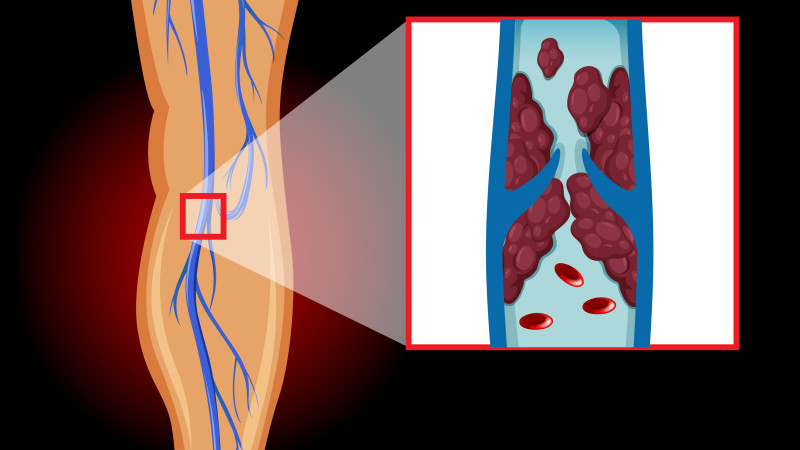 वैरिकोज वेन्स की होम्योपैथी दवा — Homeopathy Medicines For Varicose Vein in Hindi