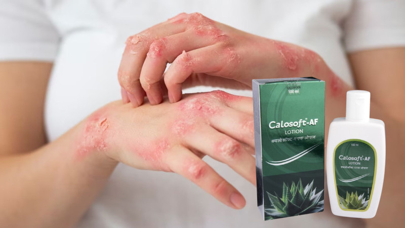 Calosoft AF Lotion: A Comprehensive Guide to Ingredients, Benefits, and Uses