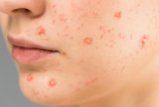 Homeopathy Medicine For Acne And Pimples: Natural Remedies for Clearer, Healthier Skin