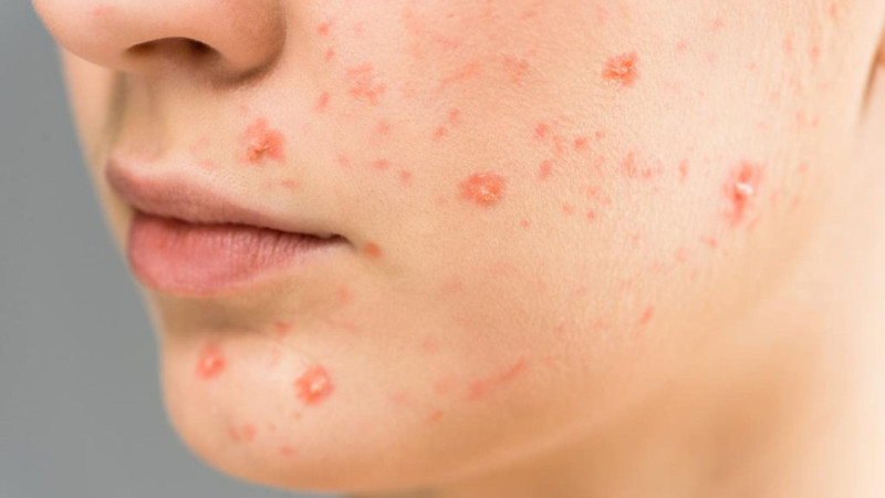 Homeopathy Medicine For Acne And Pimples: Natural Remedies for Clearer, Healthier Skin