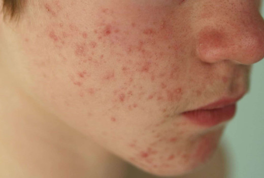 How Homeopathy Helps In Treating Skin Conditions like Melasma and Fungal Infections