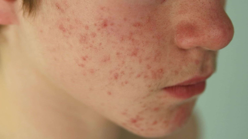 How Homeopathy Helps In Treating Skin Conditions like Melasma and Fungal Infections