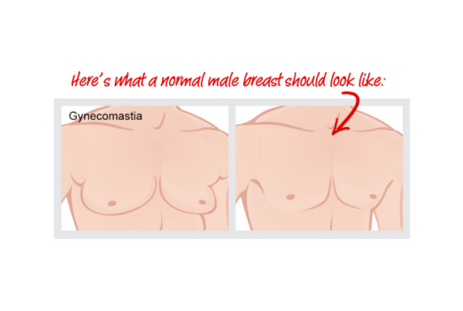Is there any medicine in homeopathy for Gynecomastia?