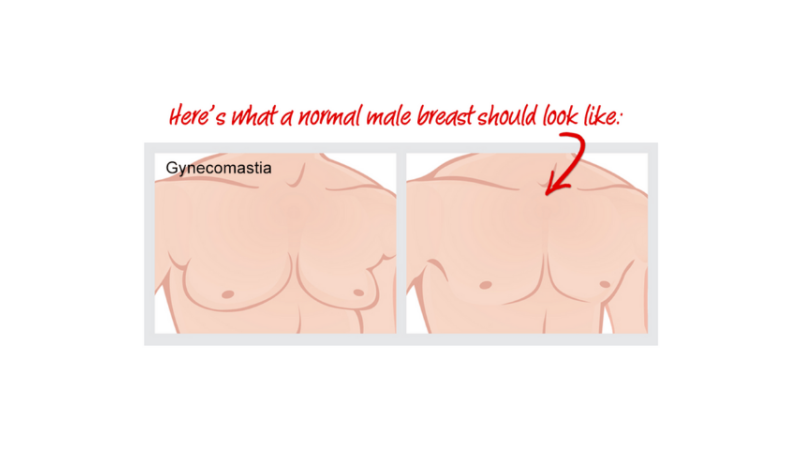 Is there any medicine in homeopathy for Gynecomastia?