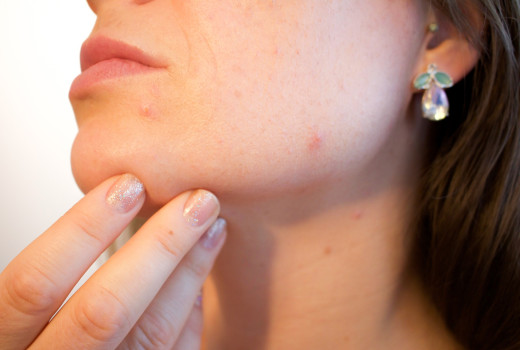 Best Homeopathic Medicines for Acne