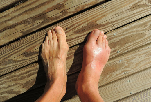 Homeopathy For Gout Treatment - Get Relief Today!