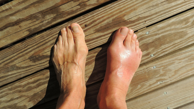 Homeopathy For Gout Treatment - Get Relief Today!