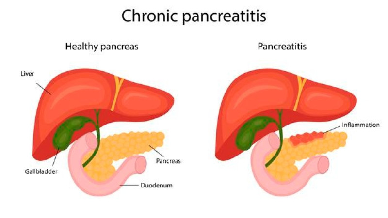 Homeopathy Treatment for ACUTE PANCREATITIS