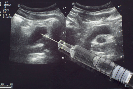 Reckeweg Aalserum 7x: Uses, Benefits, Side Effects and Dosages