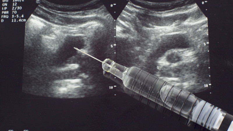 Reckeweg Aalserum 7x: Uses, Benefits, Side Effects and Dosages