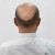 Homeopathic Medicine for Alopecia & Bald Patches