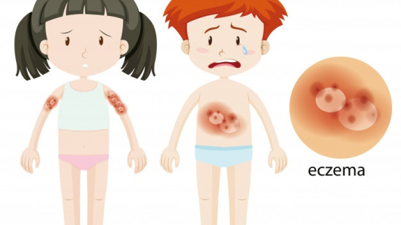 Homeopathic Medicines for Eczema