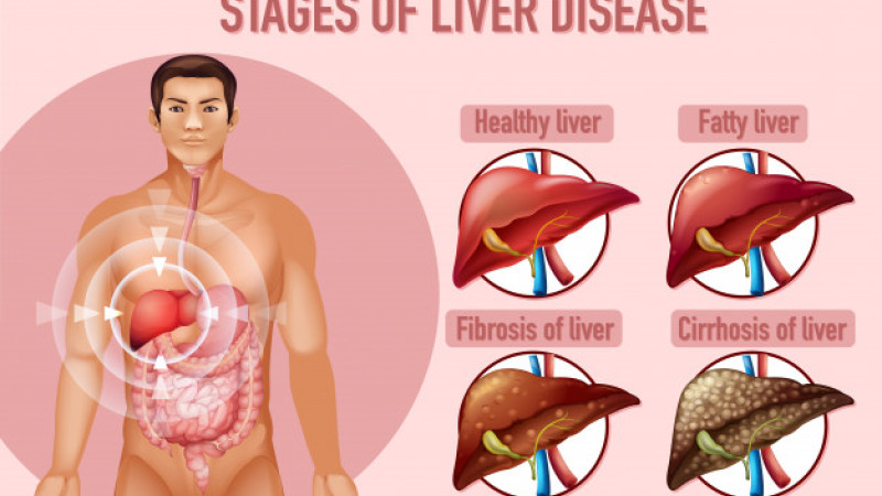 Is there any homeopathic treatment for fatty liver? If yes, how effective it is?