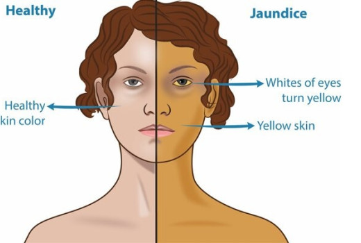 Can Jaundice be cured with Homeopathic Medicines?