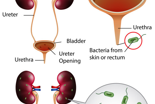 Urinary Tract Infection causes symptoms and Homeopathic medicine Hindi