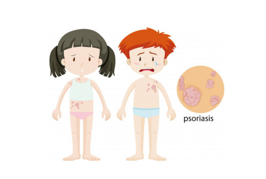 Is there any Cure for Psoriasis in Homeopathy?