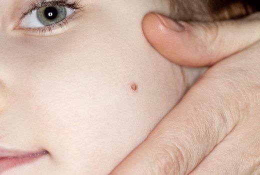 SBL Thuja Ointment- the Best Homeopathy Ointment to Treat Corn and Wart